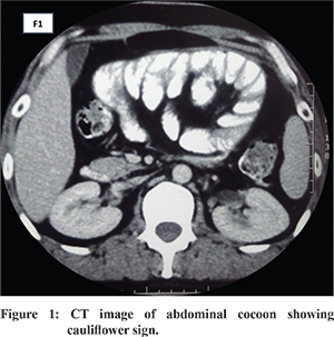 Abdominal cocoon An enigmatic entity